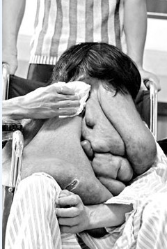 搞笑图片:超级“象面人”广州求医 面部巨瘤长过肚脐